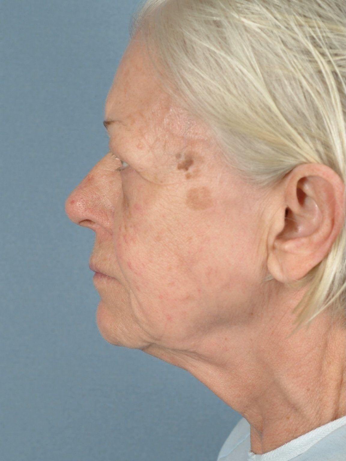 Facelift Patient Photo - Case 14178 - before view-1