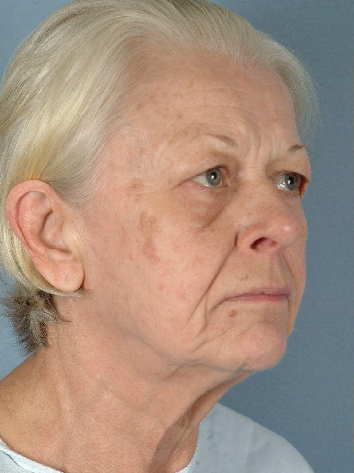 Facelift Patient Photo - Case 14178 - before view-4