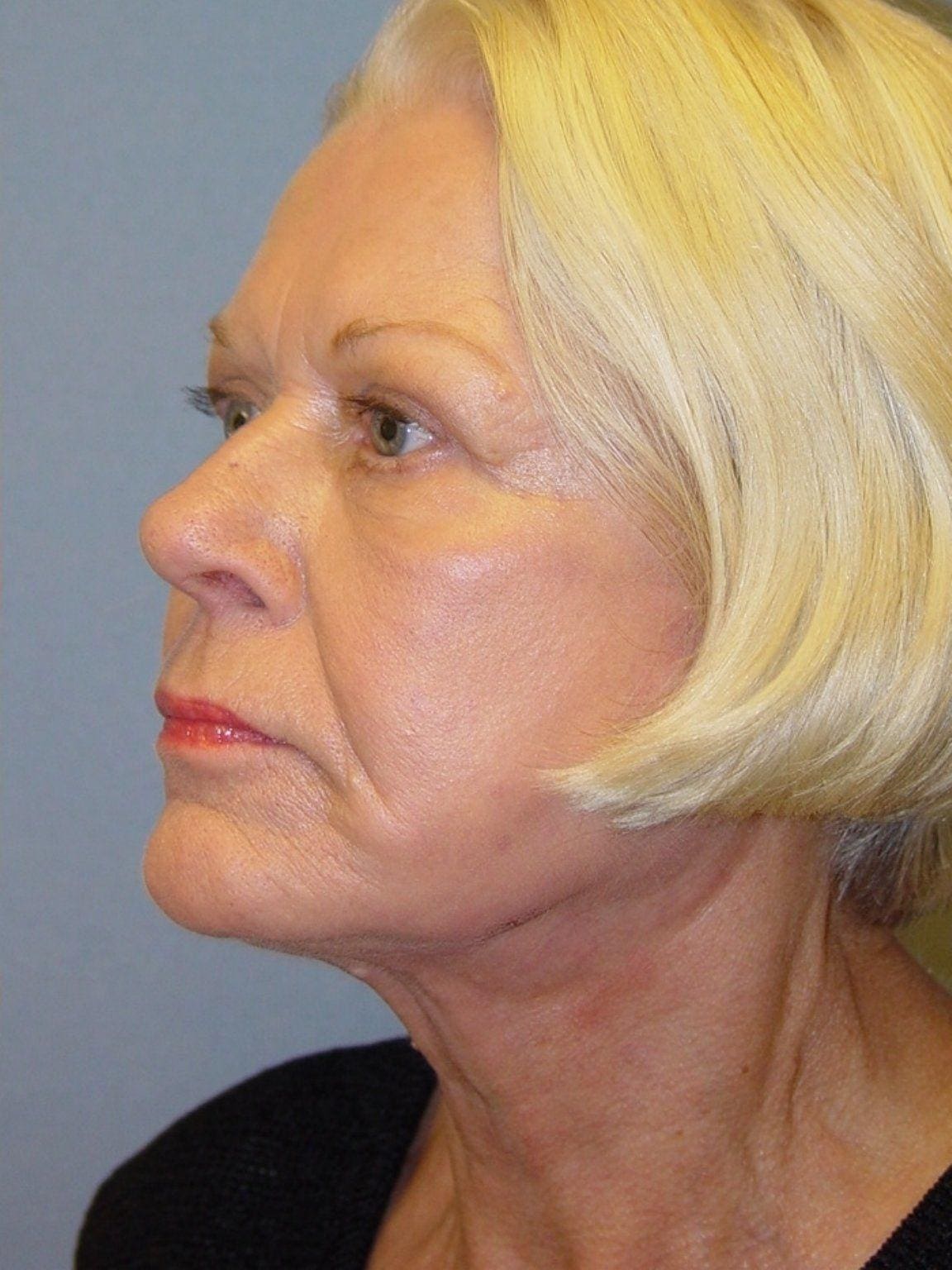 Facelift Patient Photo - Case 14178 - after view-3