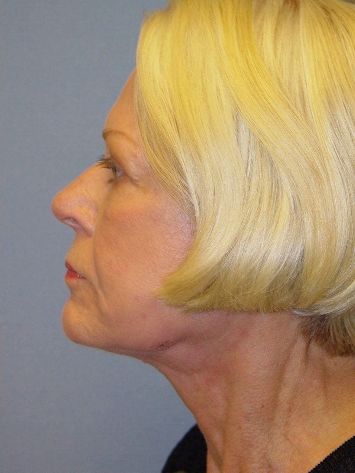 Facelift Patient Photo - Case 14178 - after view-1