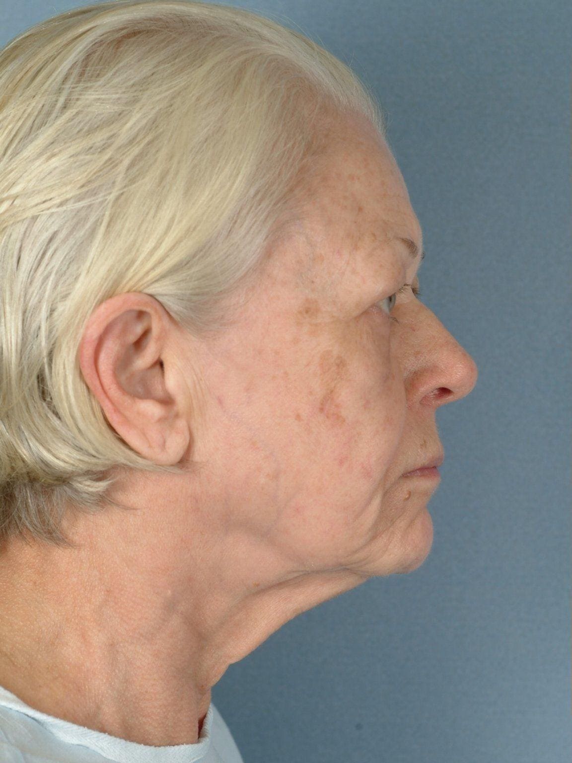 Facelift Patient Photo - Case 14178 - before view-2