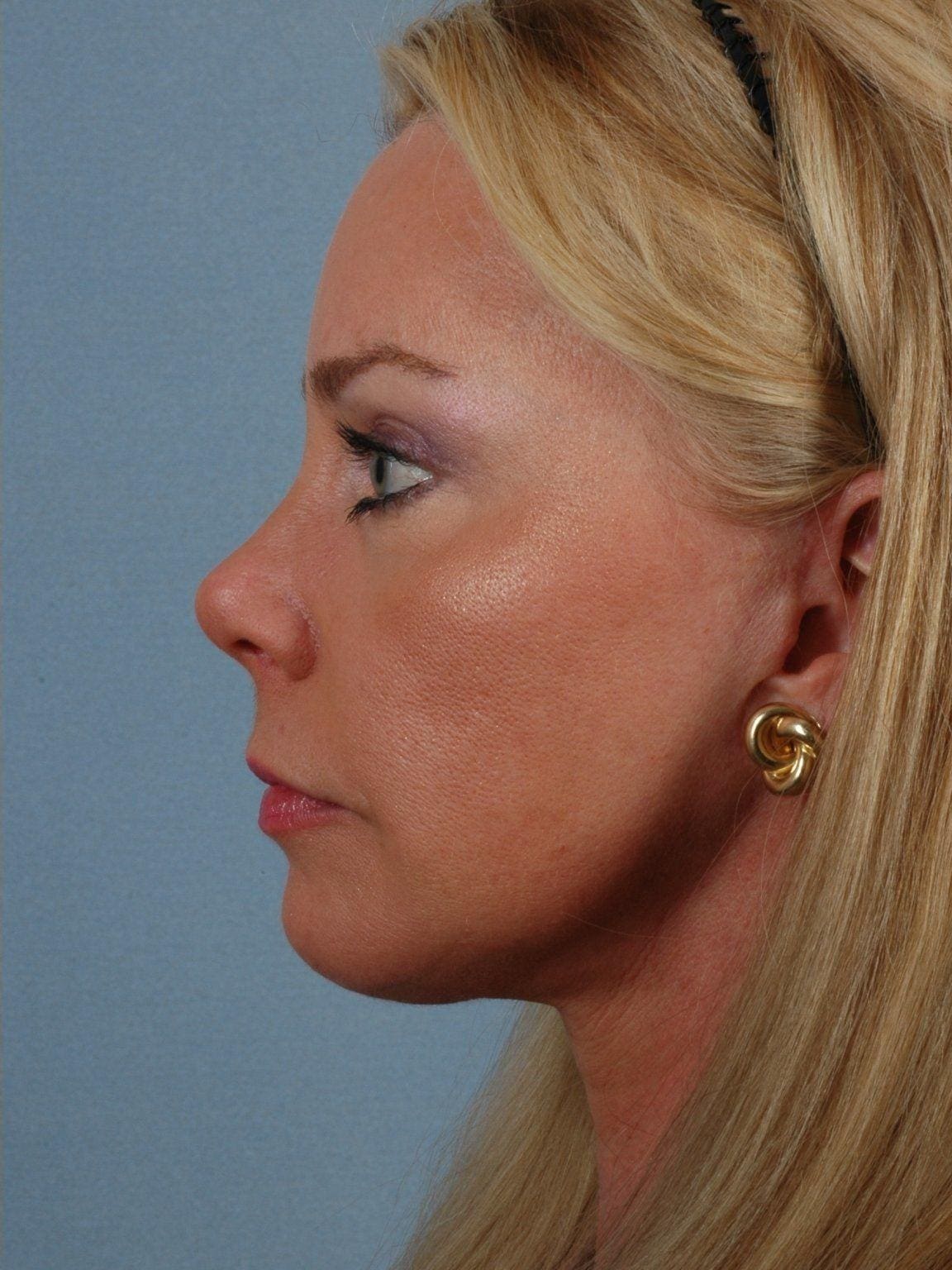 Facelift Patient Photo - Case 14190 - after view-1