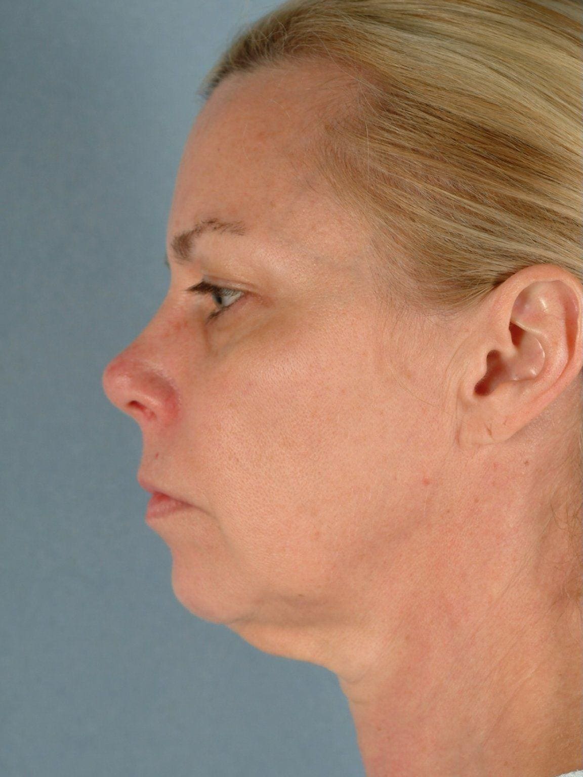 Facelift Patient Photo - Case 14190 - before view-1