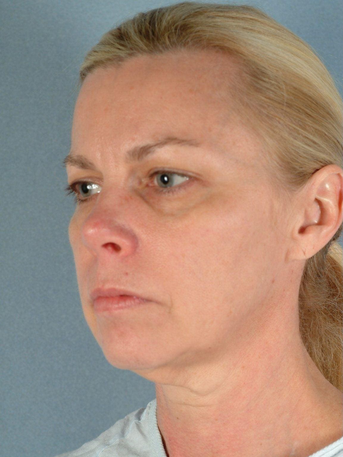 Facelift Patient Photo - Case 14190 - before view-3