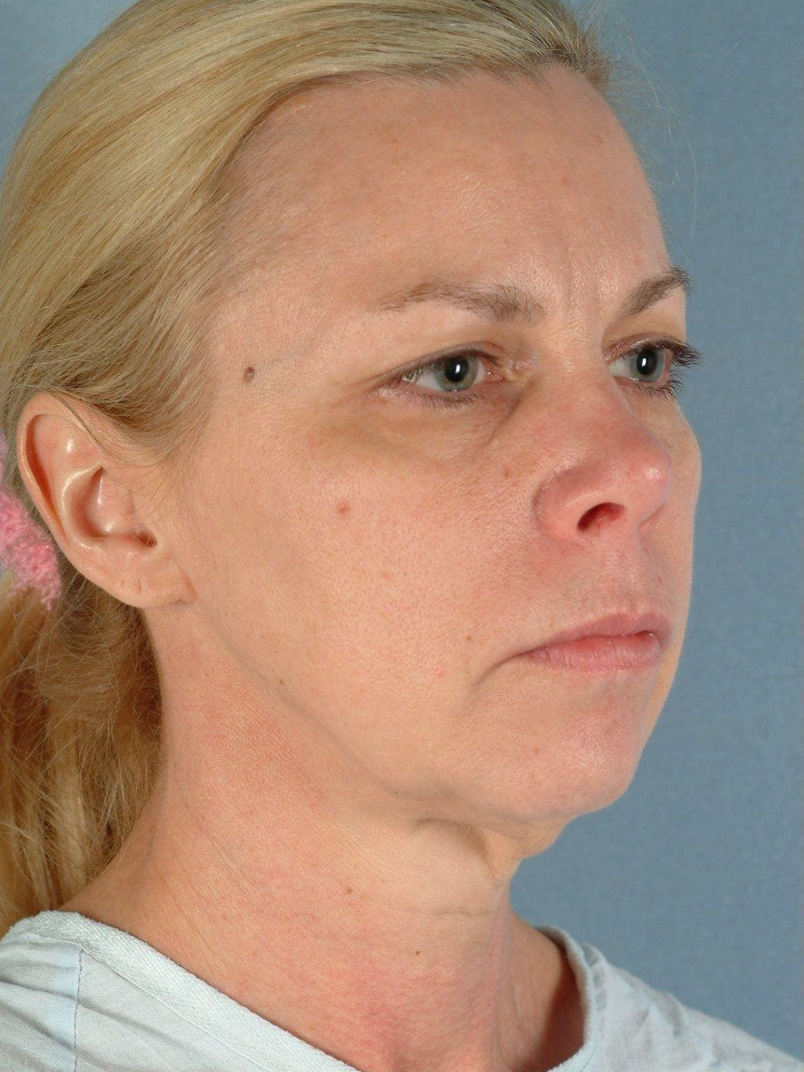 Facelift Patient Photo - Case 14190 - before view-4