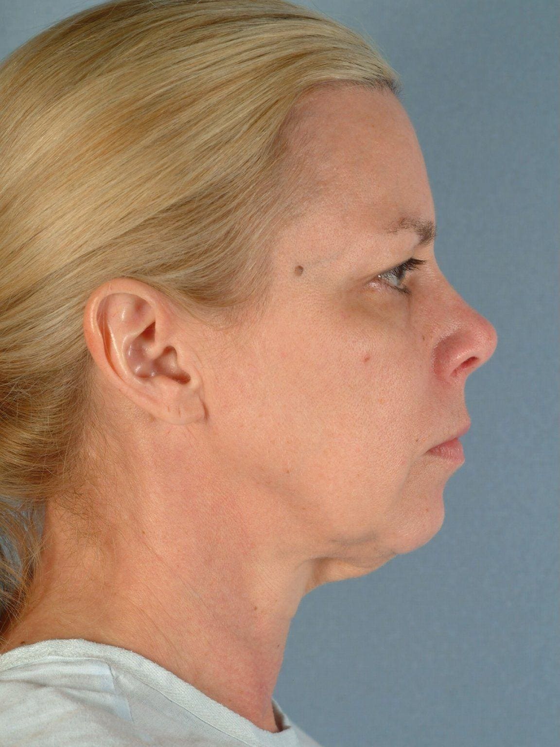 Facelift Patient Photo - Case 14190 - before view-2