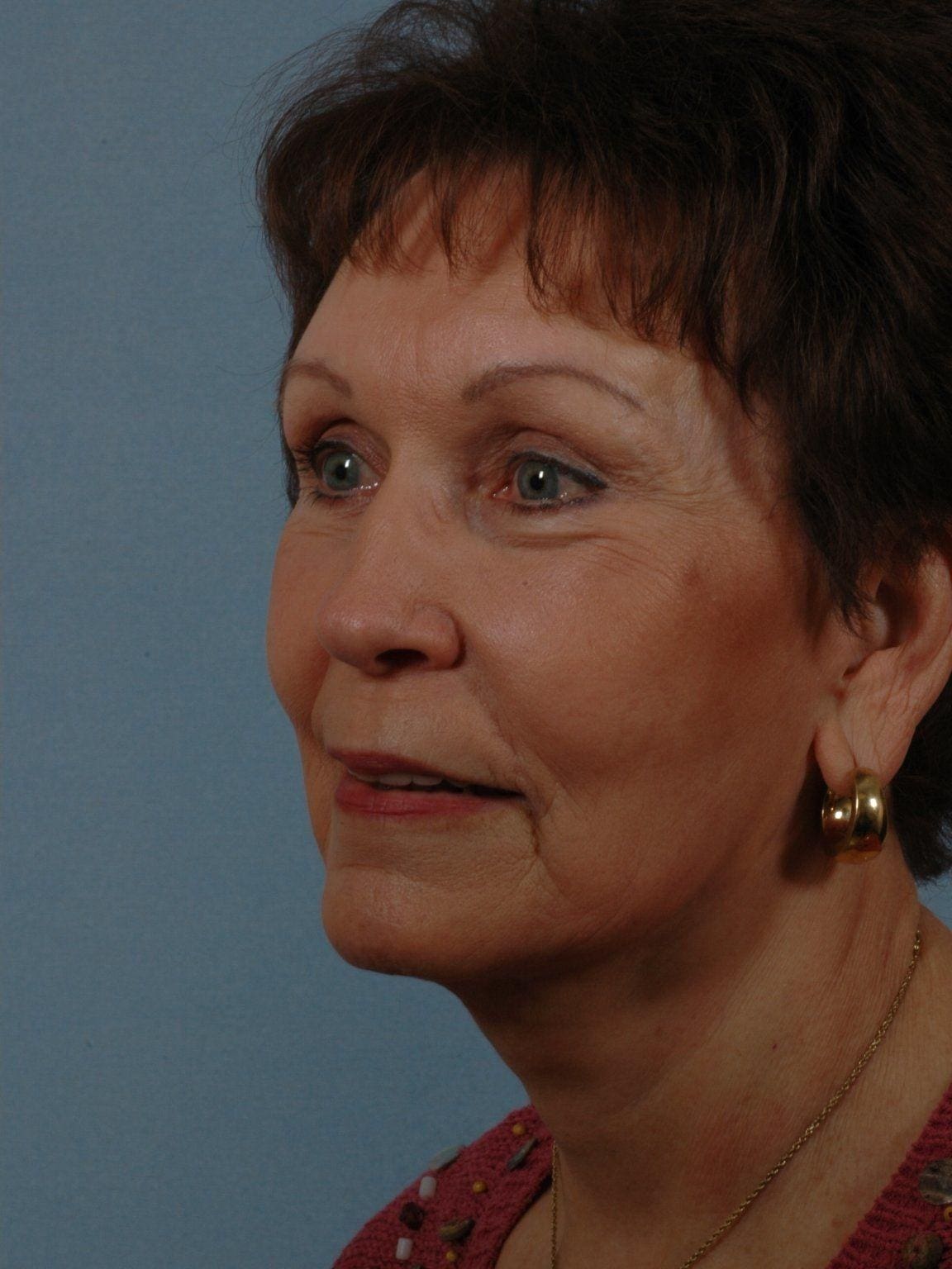 Facelift Patient Photo - Case 14202 - after view-3