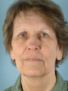 Facelift - Case 14202 - Before