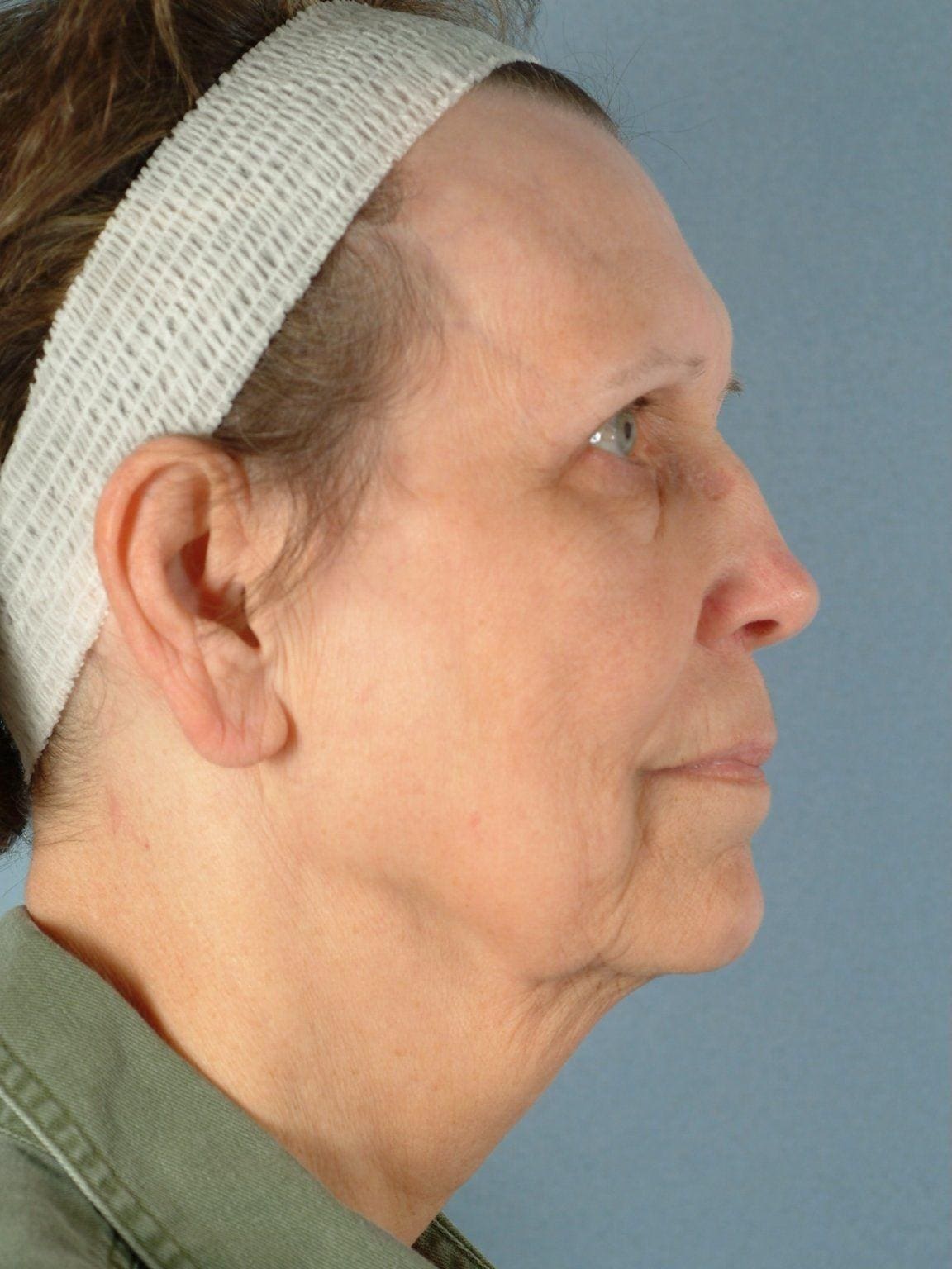 Facelift Patient Photo - Case 14202 - before view-2