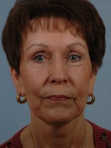 Facelift - Case 14202 - After