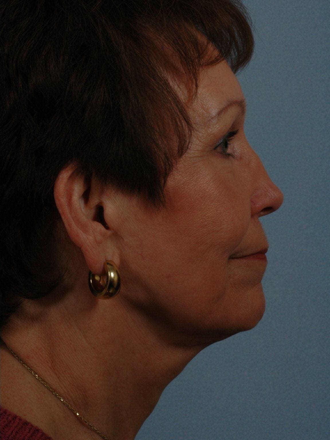 Facelift Patient Photo - Case 14202 - after view-2