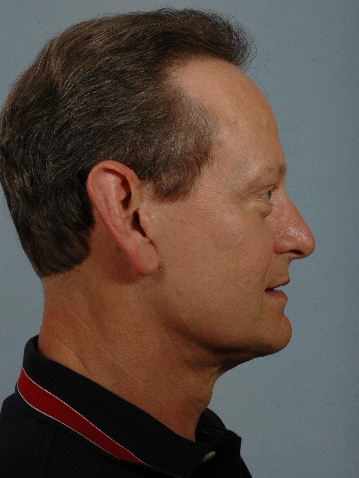 Facelift Patient Photo - Case 14214 - after view-2