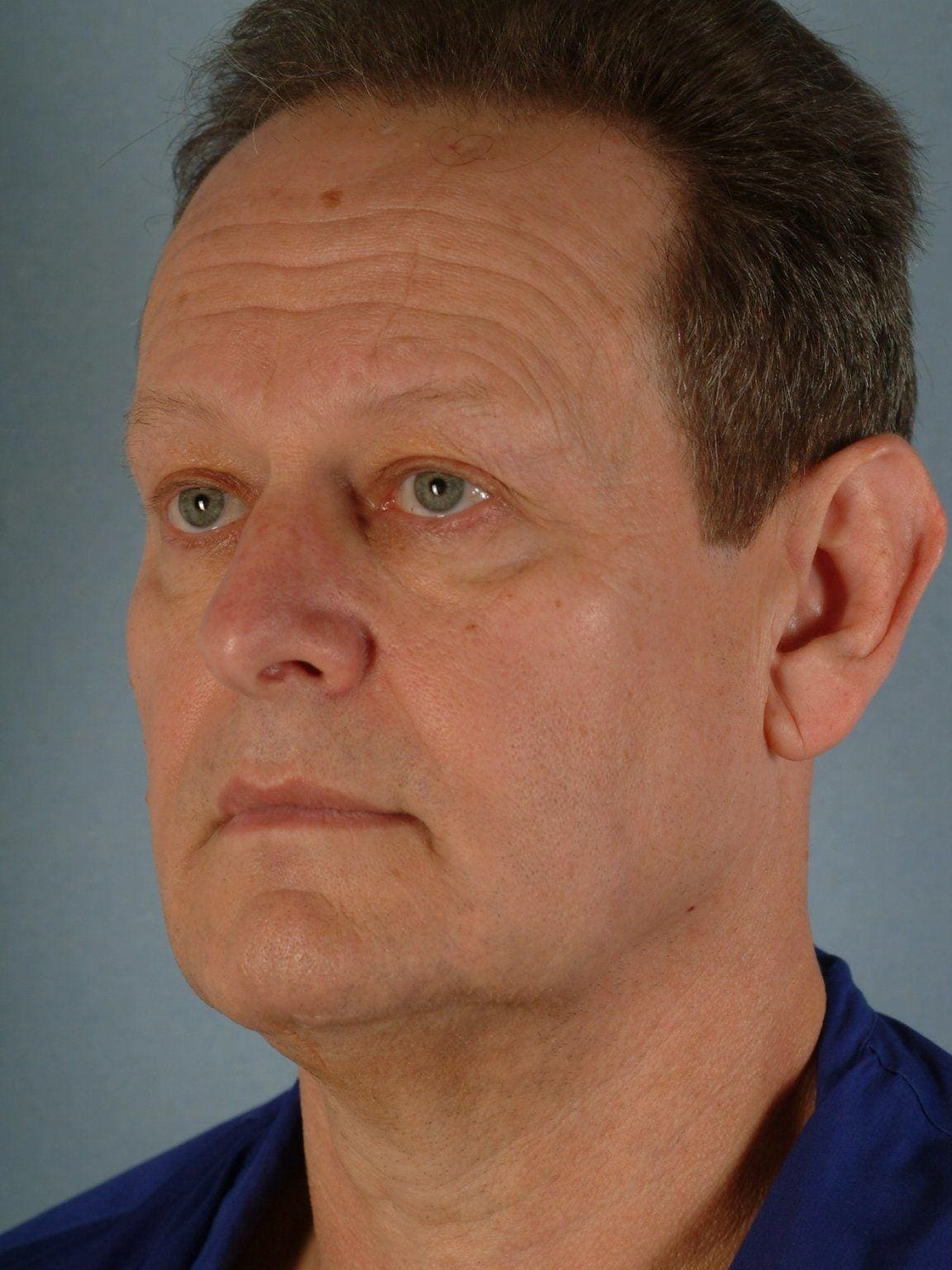 Facelift Patient Photo - Case 14214 - before view-3