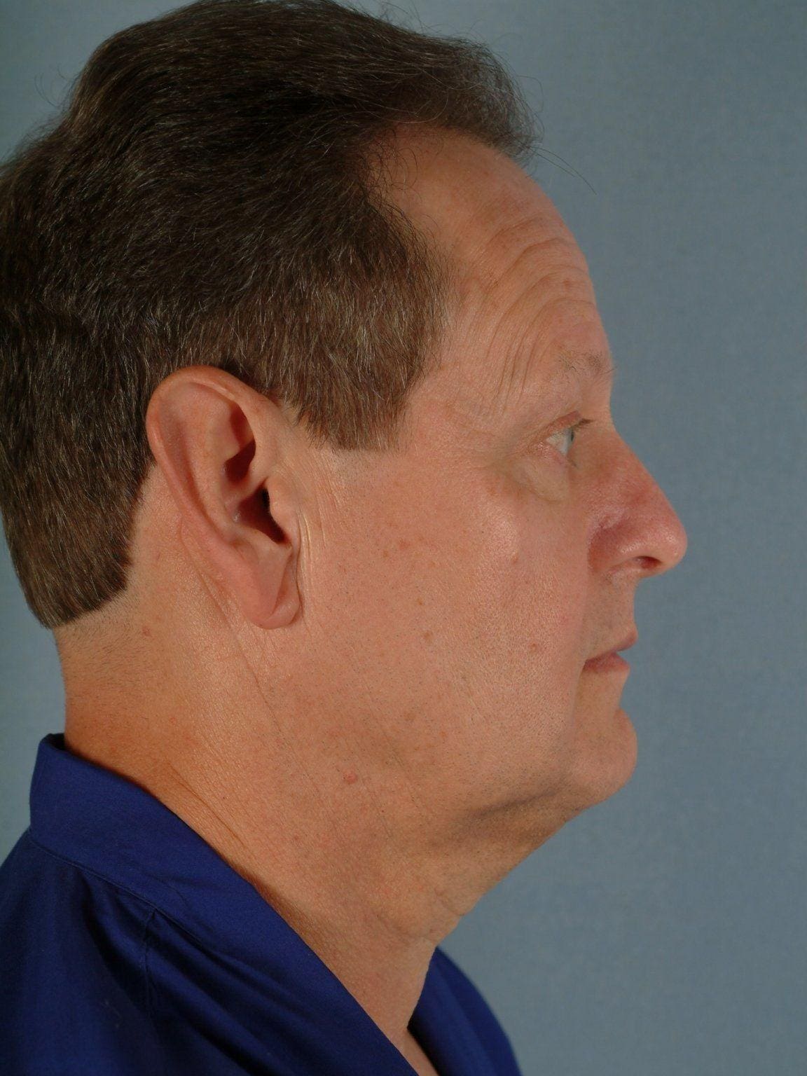 Facelift Patient Photo - Case 14214 - before view-2