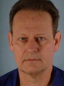 Facelift - Case 14214 - Before