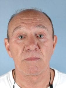 Facelift - Case 14226 - After