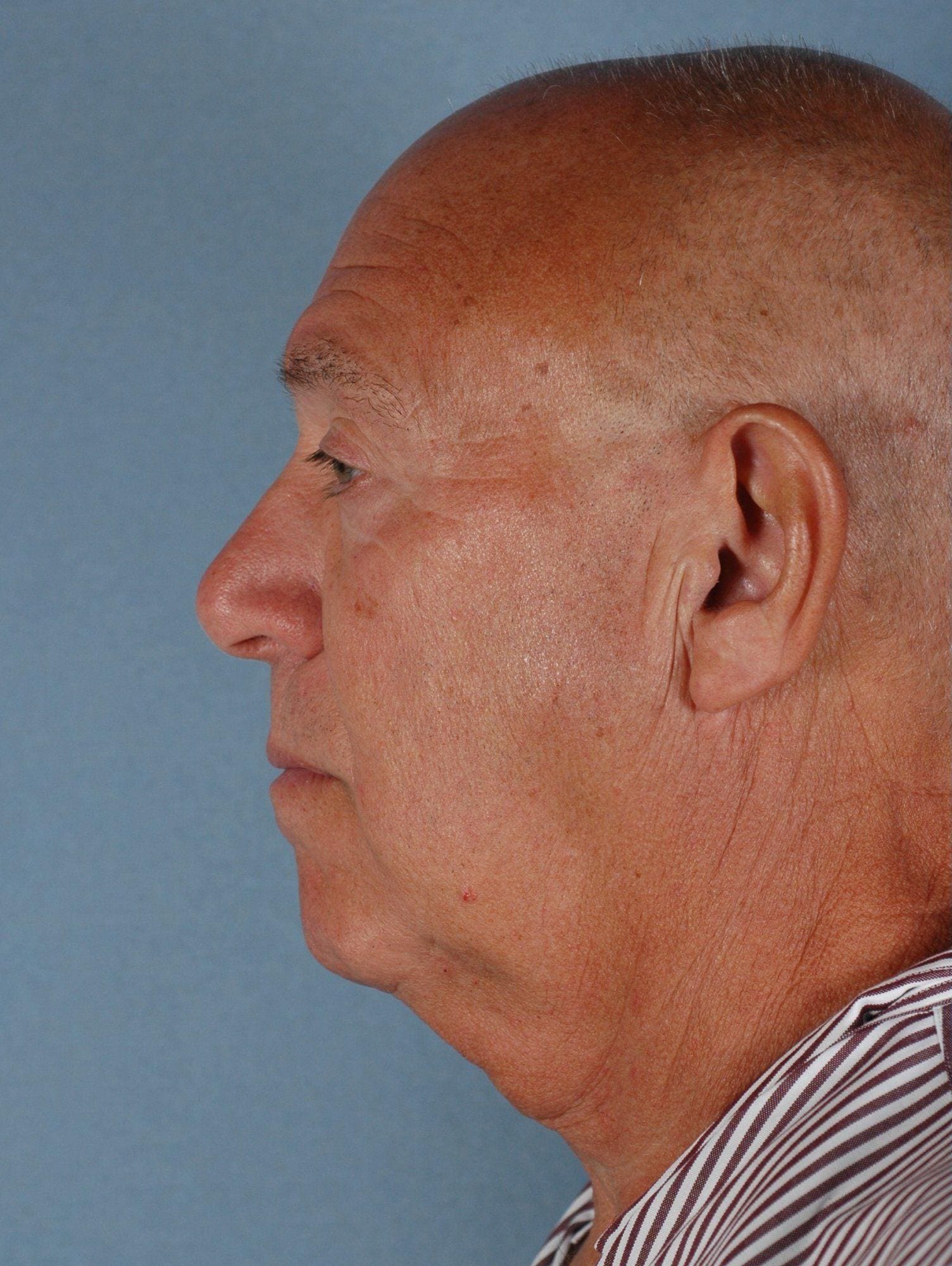 Facelift Patient Photo - Case 14226 - before view-1