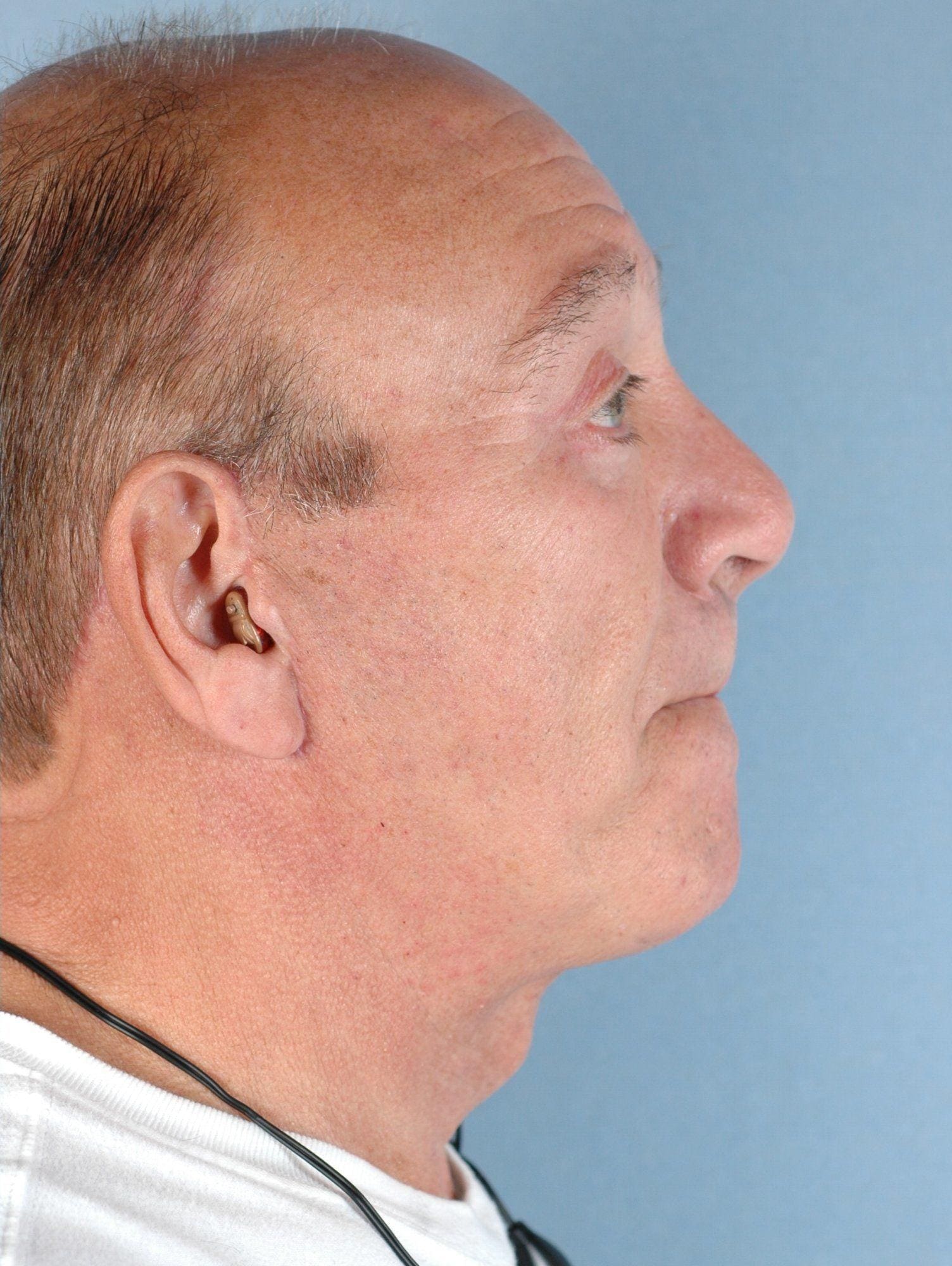 Facelift Patient Photo - Case 14226 - after view-2