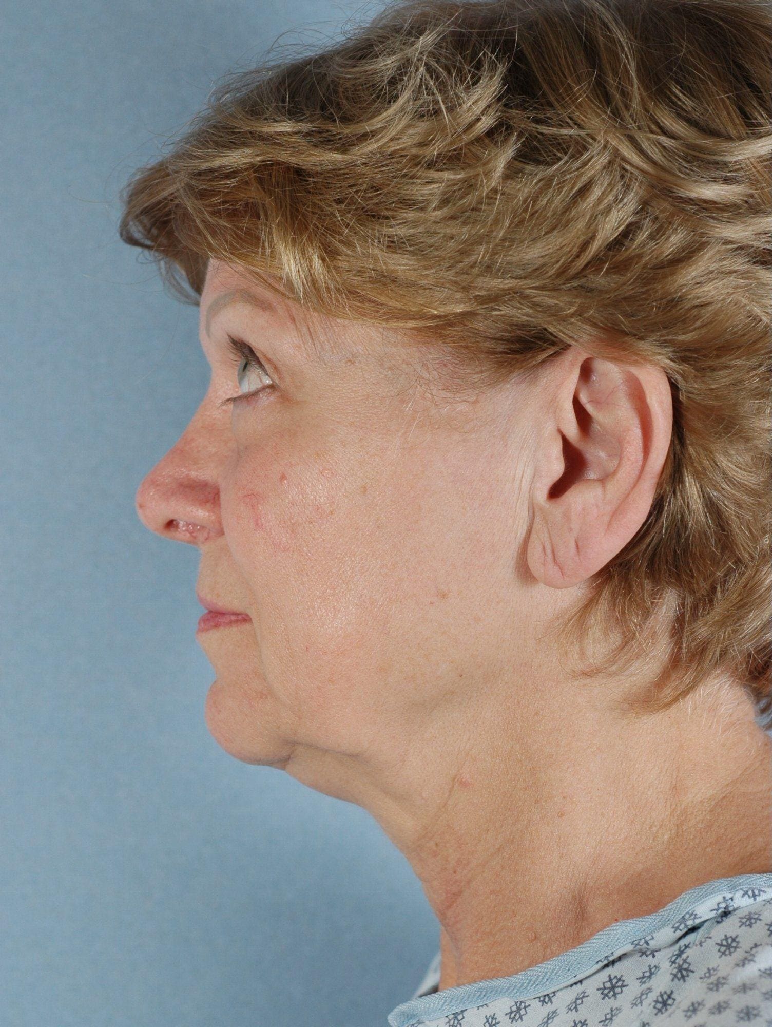 Facelift Patient Photo - Case 14238 - before view-1