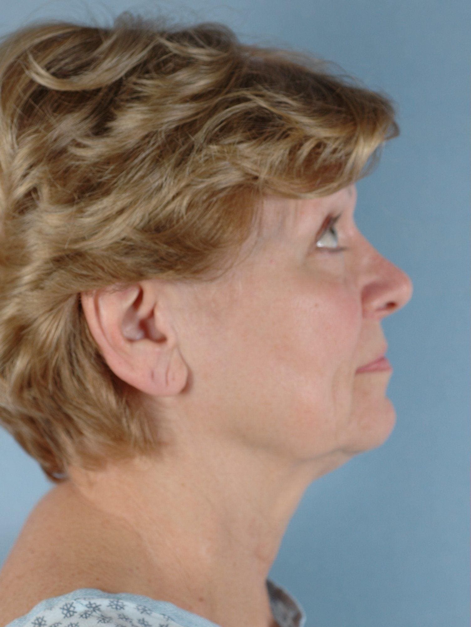 Facelift Patient Photo - Case 14238 - before view-2