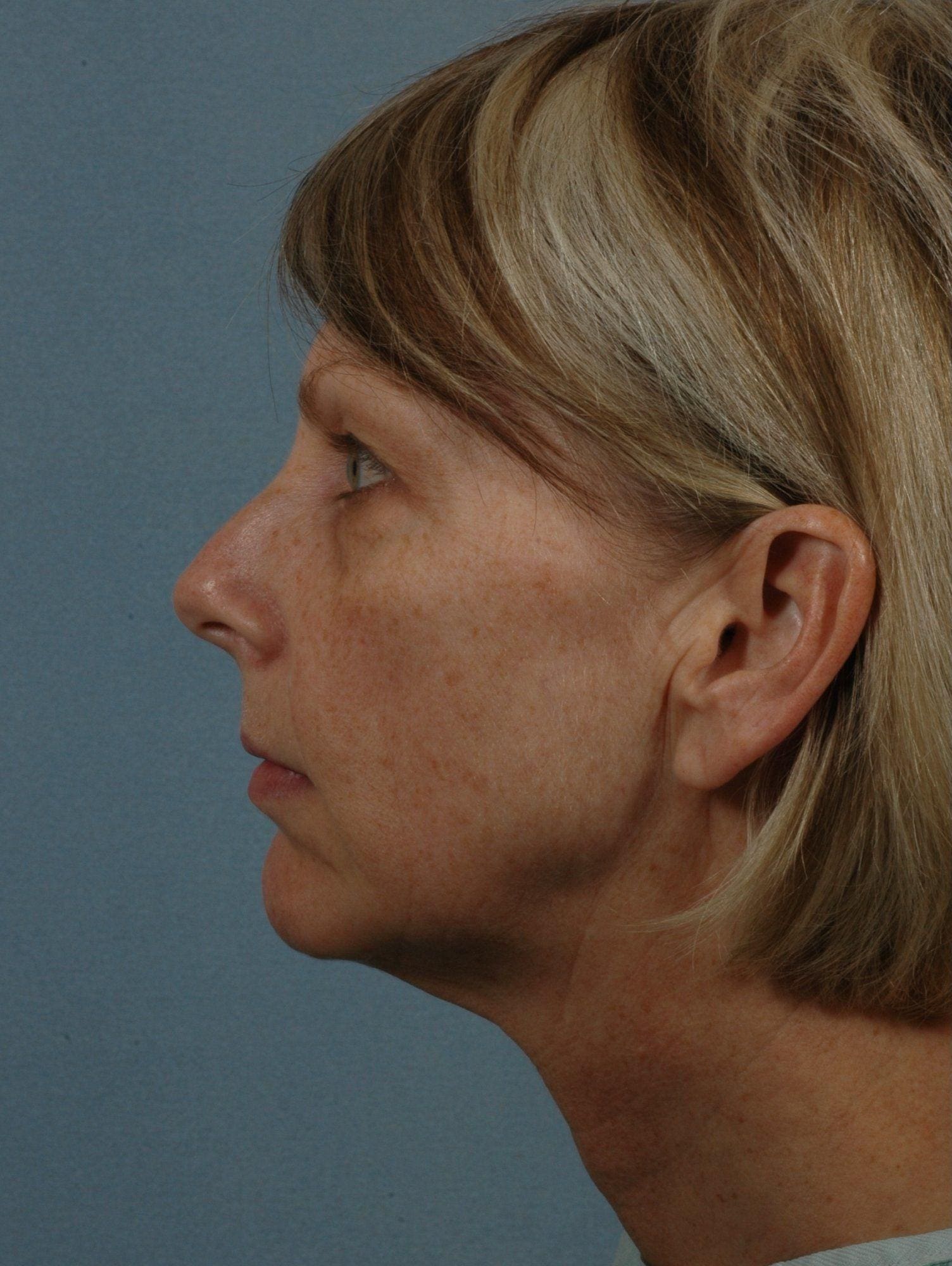 Facelift Patient Photo - Case 14250 - before view-1