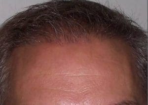 Hair Restoration - Case 14270 - After