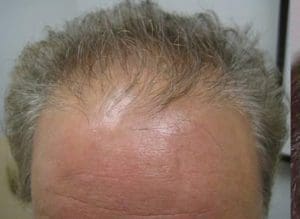 Hair Restoration - Case 14270 - Before