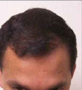 Hair Restoration - Case 14274 - After