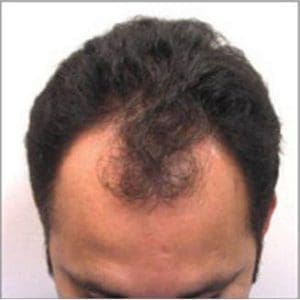 Hair Restoration - Case 14274 - Before