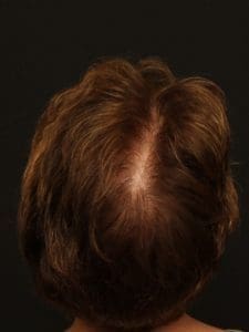 Hair Restoration - Case 14285 - After