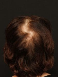 Hair Restoration - Case 14285 - Before