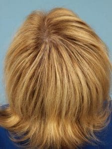 Hair Restoration - Case 14289 - After