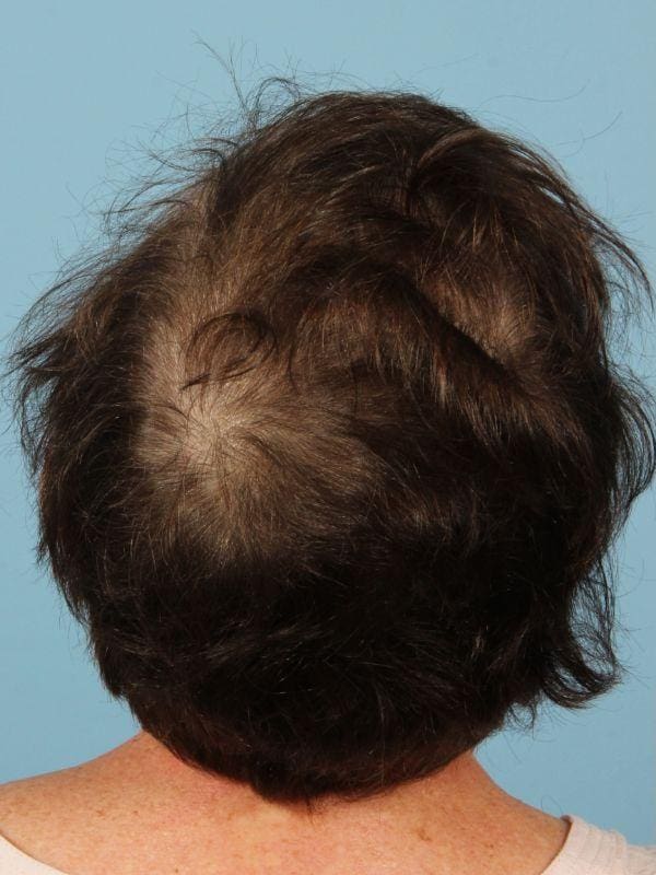 Hair Restoration Patient Photo - Case 14293 - before view-