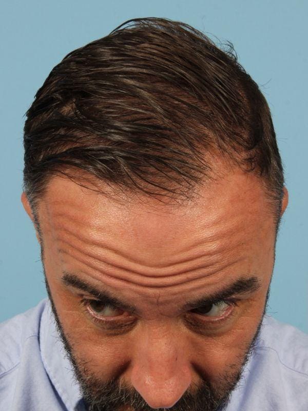 Hair Restoration Patient Photo - Case 14302 - before view-