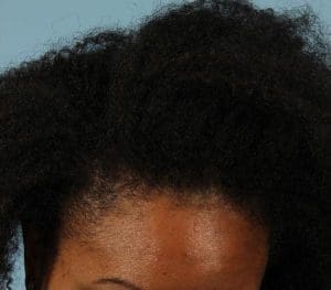 Hair Restoration - Case 14306 - After