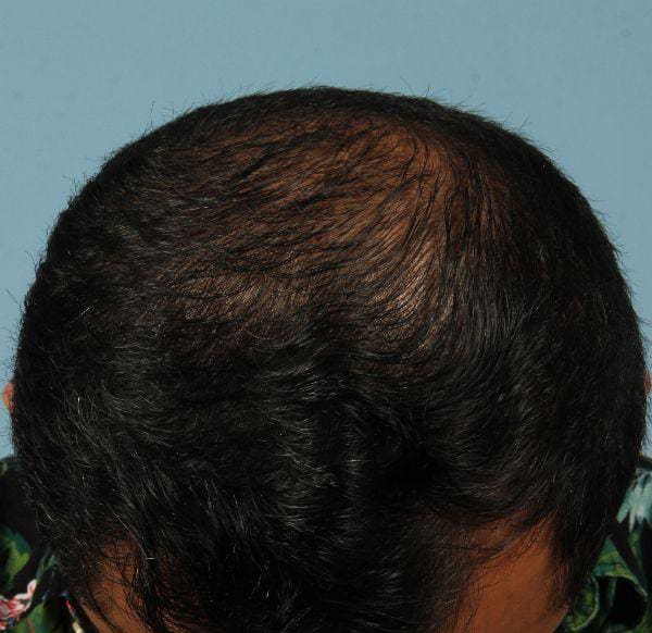 Hair Restoration Patient Photo - Case 14314 - before view-1