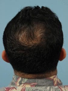 Hair Restoration - Case 14314 - After