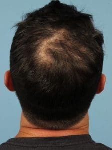 Hair Restoration - Case 14320 - Before