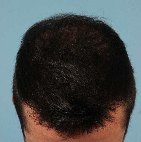 Hair Restoration Patient Photo - Case 14320 - after view-1