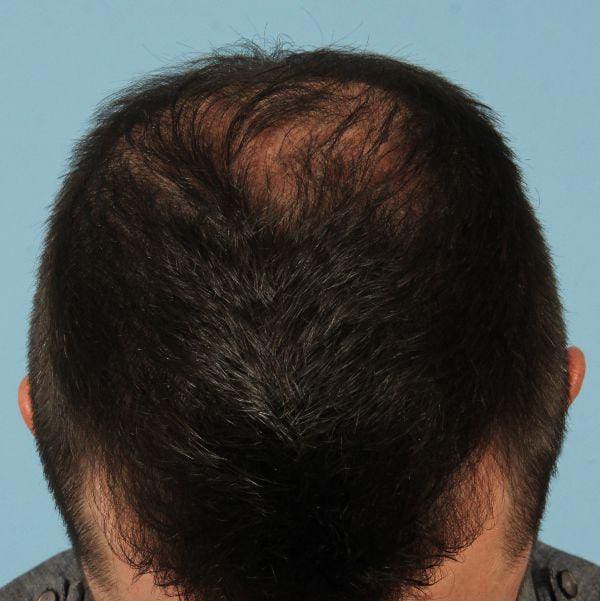 Hair Restoration Patient Photo - Case 14320 - before view-1