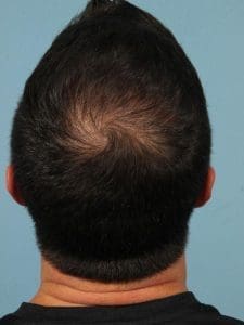 Hair Restoration - Case 14320 - After