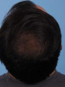 Hair Restoration - Case 14326 - After