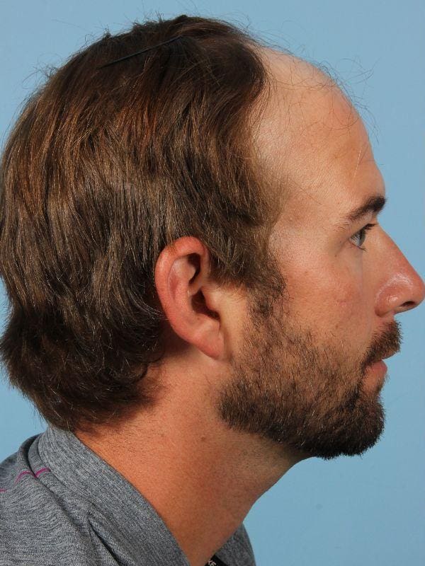 Hair Restoration Patient Photo - Case 14332 - before view-2