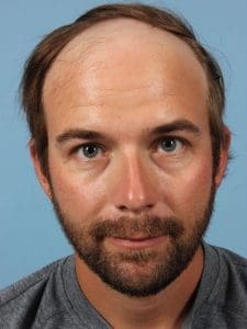 Hair Restoration - Case 14332 - Before