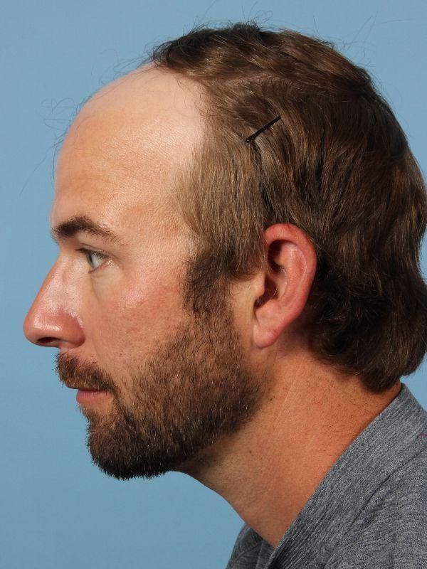 Hair Restoration Patient Photo - Case 14332 - before view-1