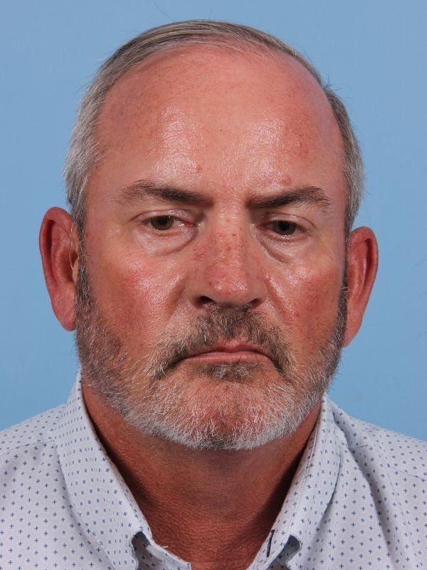 Hair Restoration Patient Photo - Case 14342 - before view-