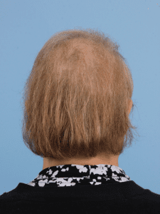 Hair Restoration - Case 14348 - Before