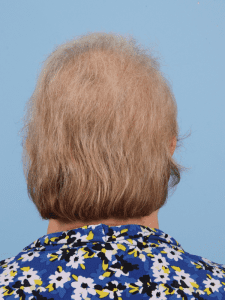 Hair Restoration - Case 14348 - After