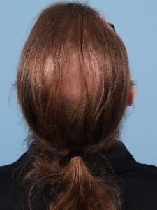 Hair Restoration - Case 14358 - Before