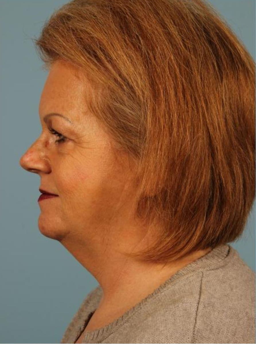 Kybella Patient Photo - Case 14362 - before view-1